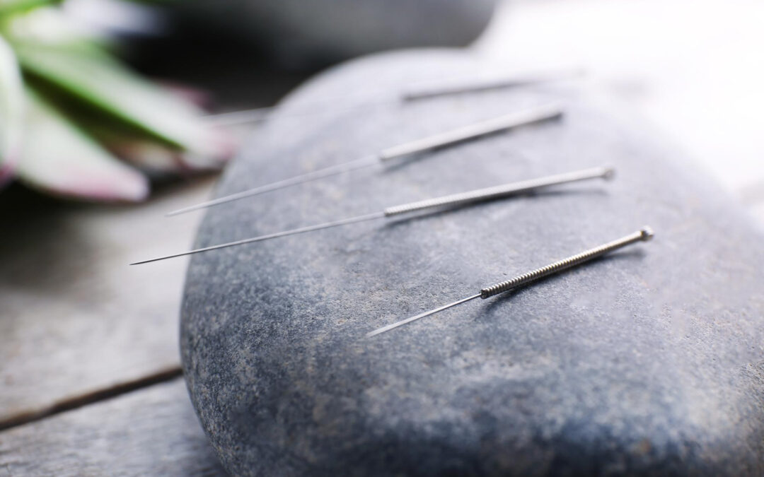 Acupuntura Indolora: Qué es Toyohari y para Quién Está Indicada