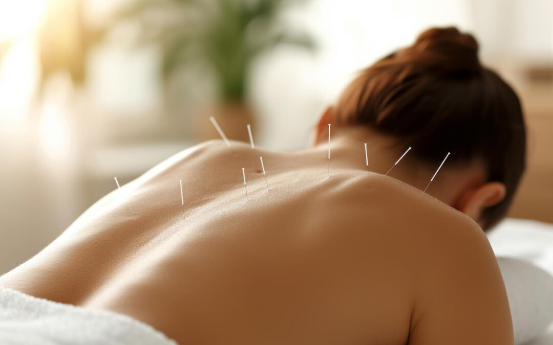Beneficios de la Acupuntura para la Ansiedad